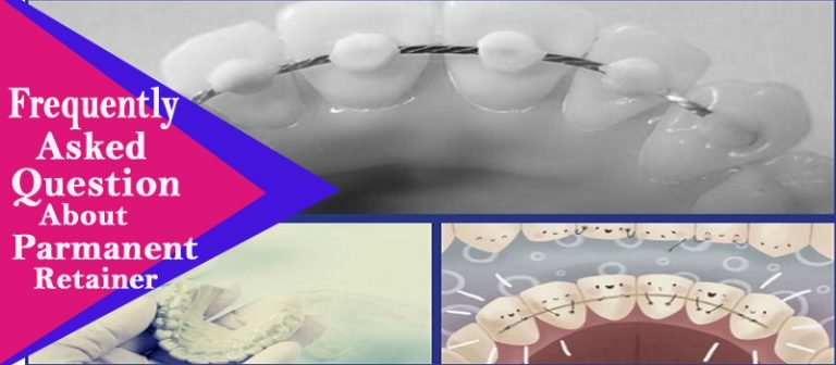 Permanent Retainers: Advantage, Disadvantage, Cost, And More - ShareInfo